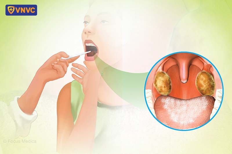 Bệnh bạch hầu lây qua đường hô hấp