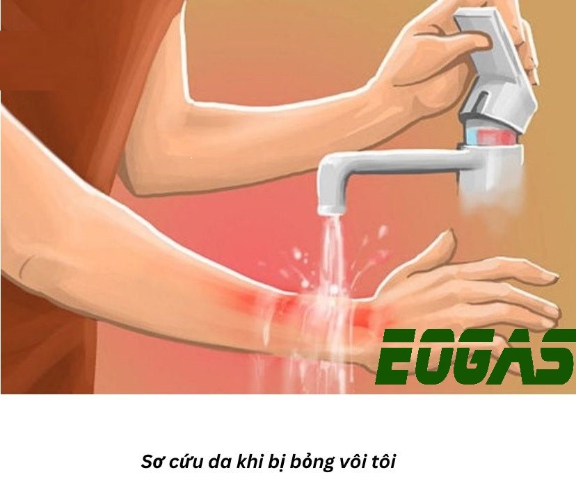Sơ cứu khi tiếp xúc với vôi tôi
